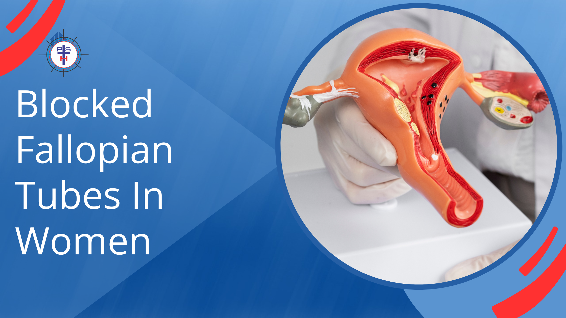 Blocked Fallopian Tube In Women
