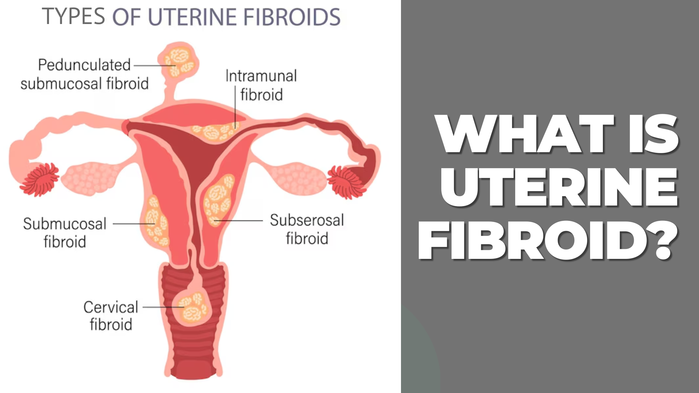 Uterine Fibroid Treatment.