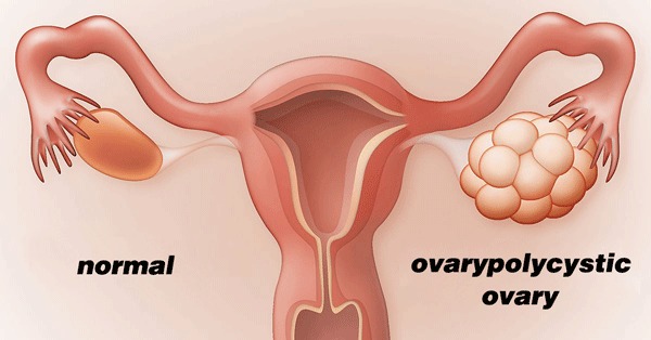 Polycystic Ovary Syndrome and Endometriosis