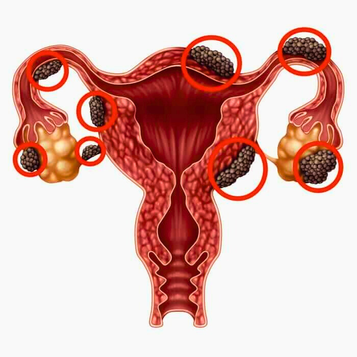 Endometriosis